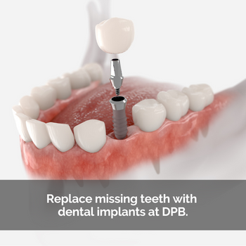 Dental implants. Caption: Replace missing teeth with dental implants at DPB