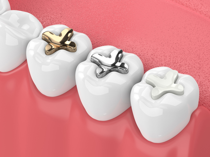 3D rendering of three teeth, one with tooth-colored filling, one with silver filling, and one with gold filling.