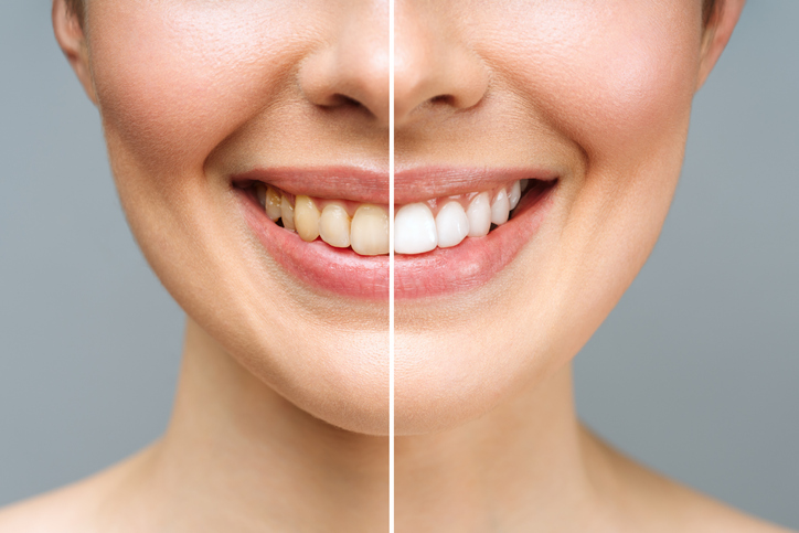 Before and after teeth whitening of woman's teeth