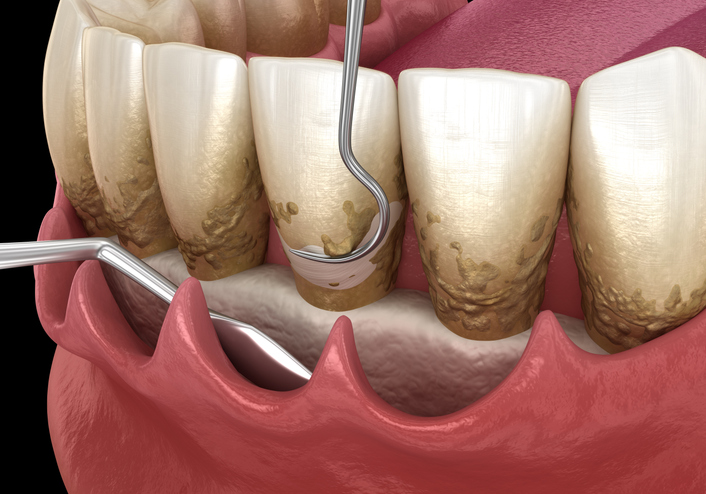 periodontal flap surgery showing dental tool below the gumline