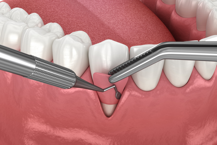 gum grafting procedure