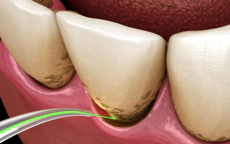 Laser removes gum disease tissue.