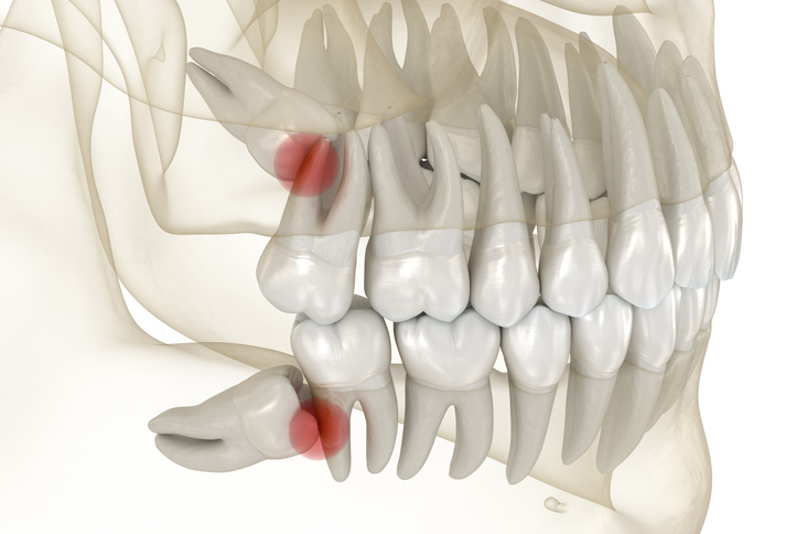 Impacted wisdom teeth X-ray.