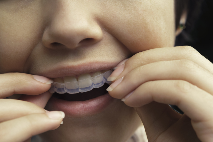 female putting in Invisalign aligners