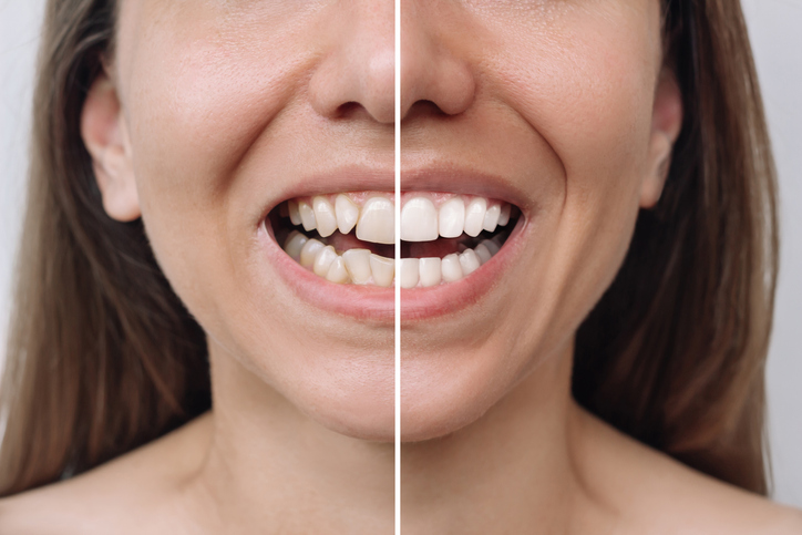 A young Caucasian woman before and after dental veneers and other cosmetic dentistry treatments.