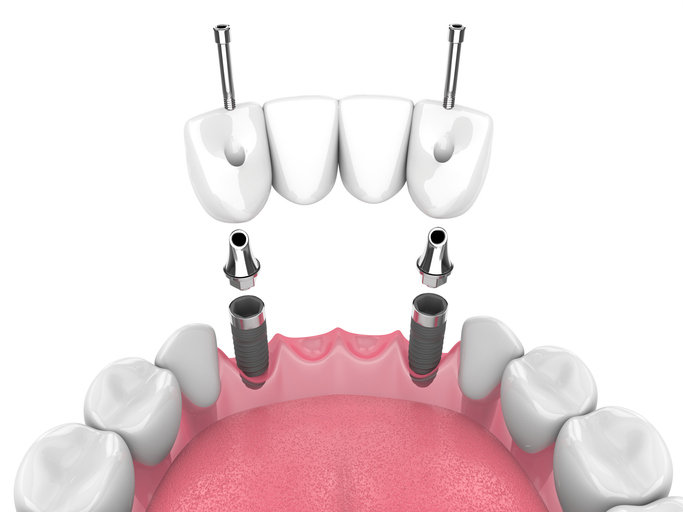 Dental bridge with four crowns supported by two dental implants