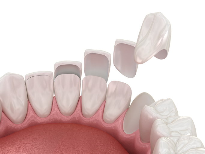 Dental veneer placement over frontal teeth.