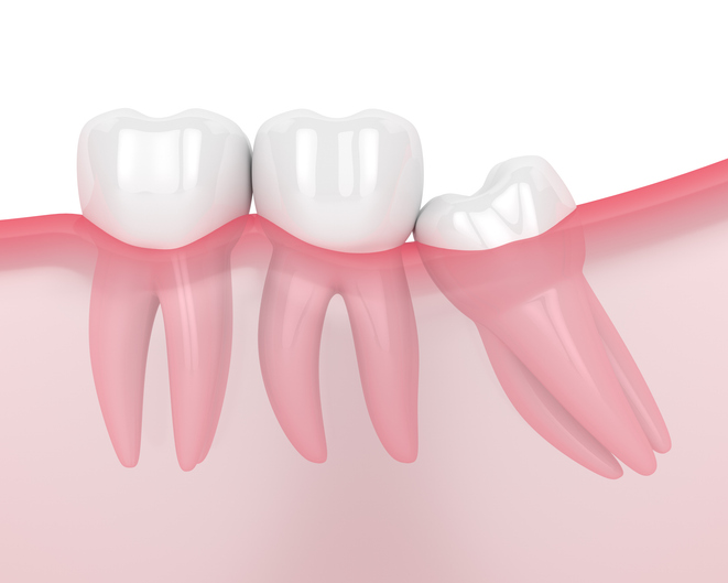 Impacted wisdom tooth