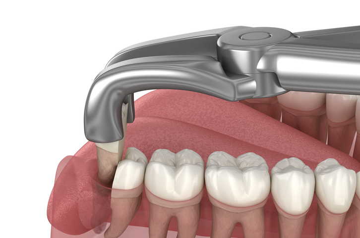 Dental tool removing a wisdom tooth